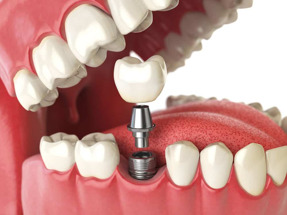 Why Dental Implants