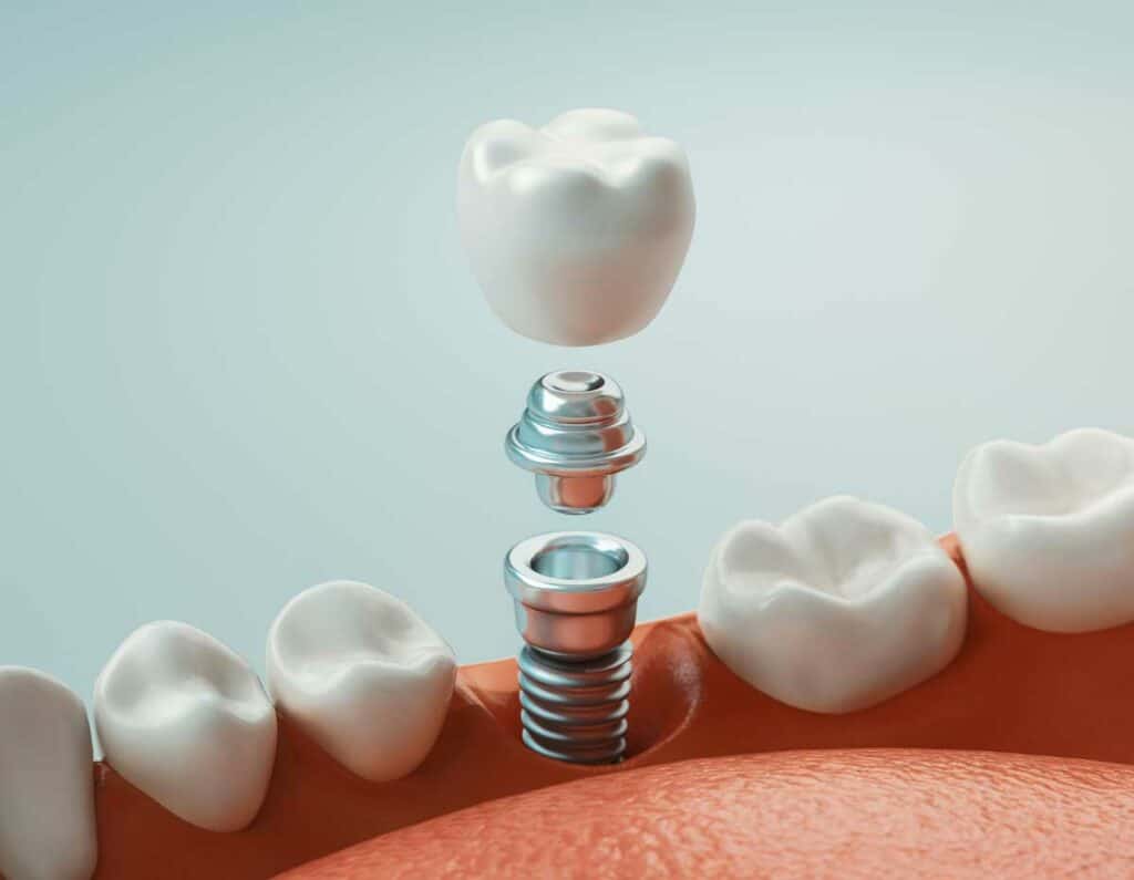 What is a dental implant