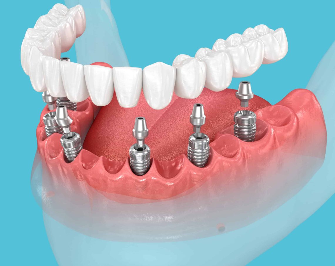Mandibular prosthesis with gum supported by 6 implants. 3D illustration of human teeth and dentures concept