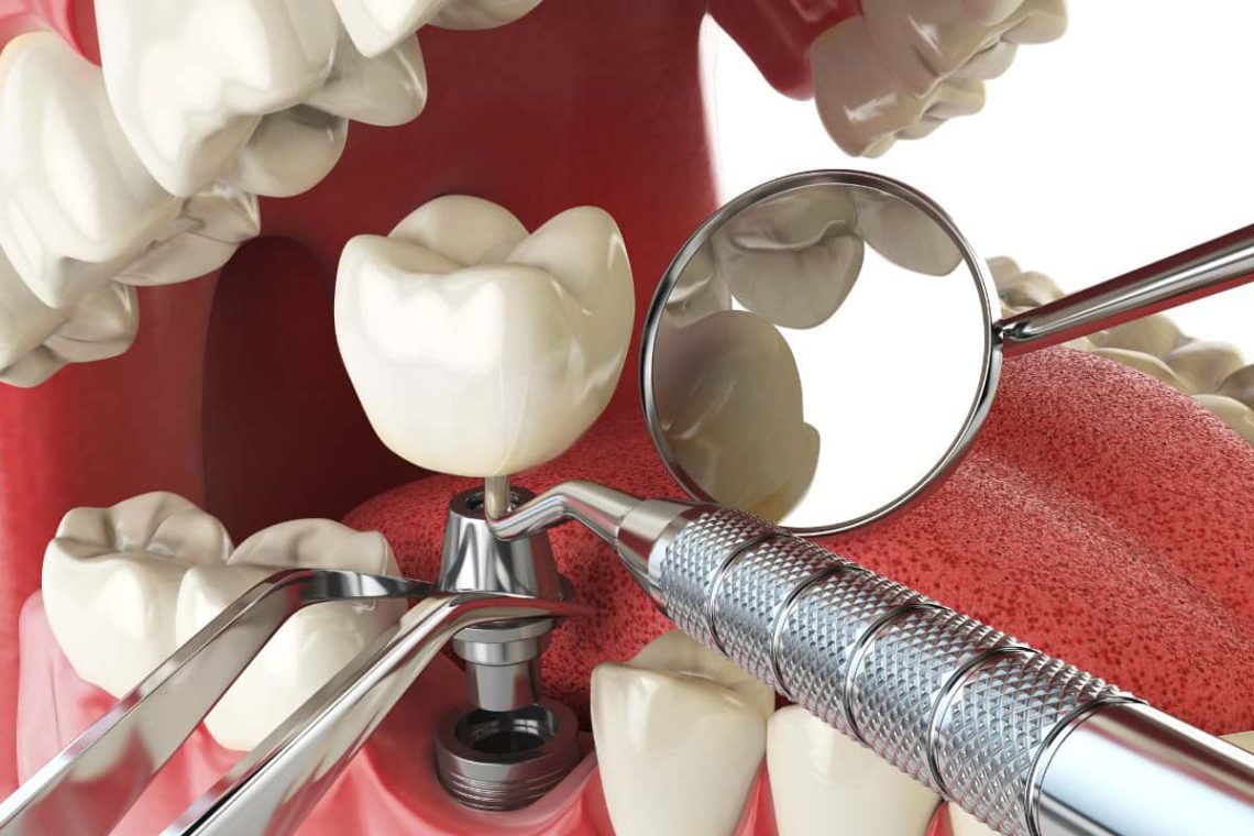 california-dental-implants-specialists (1)