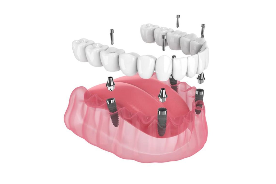california-dental-implants-specialists (5)