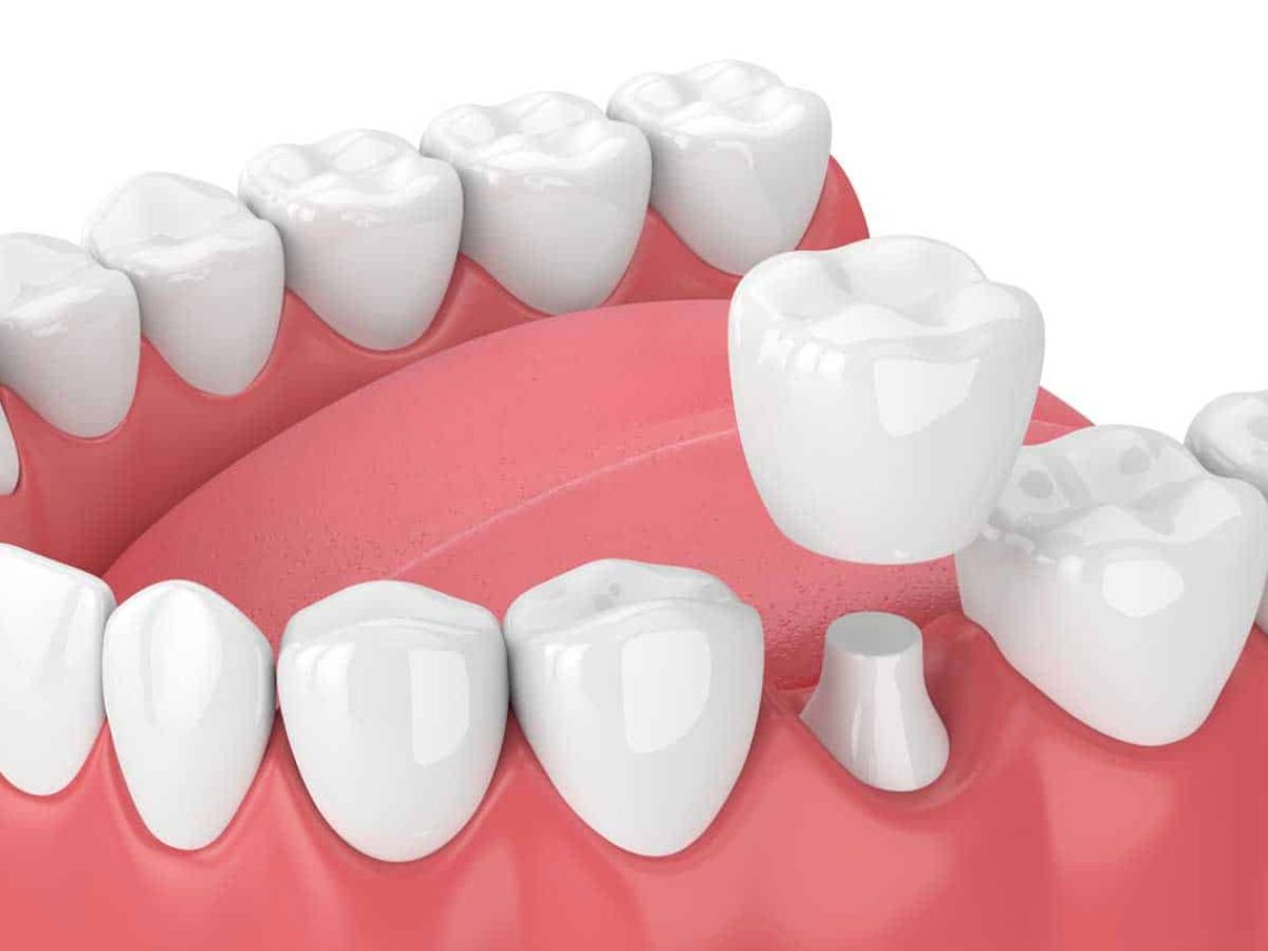 When should I get a dental implant?